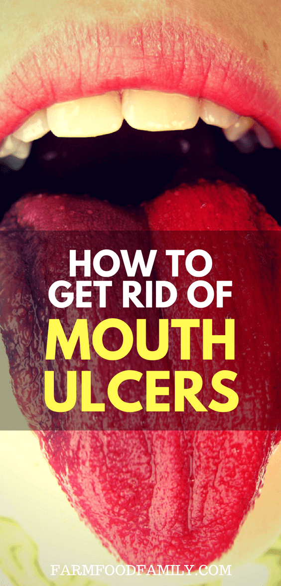 Mouth Ulcer﻿﻿s are very common and are often linked to stress or hormones. It’s well recognized that they can be caused by a deficiency in iron and lack of some vitamins, such as B12. 