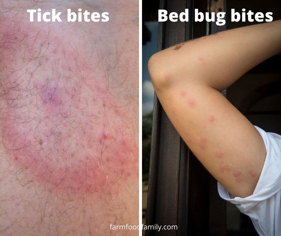bed bug bites vs tick bites